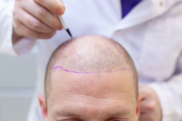 preparation-hair-transplant-surgery_262891-2